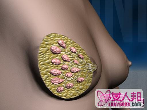>什么会得多发性乳腺纤维瘤 两种治疗措施你知道吗