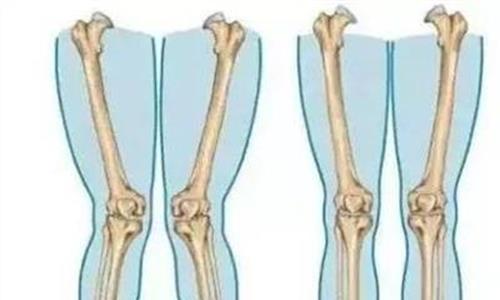 >跑步膝关节外侧痛 全方位解析:跑步膝关节损伤如何自我治疗