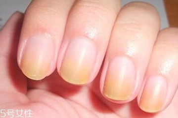 指甲变黄怎么调理 指甲变黄的治疗方法