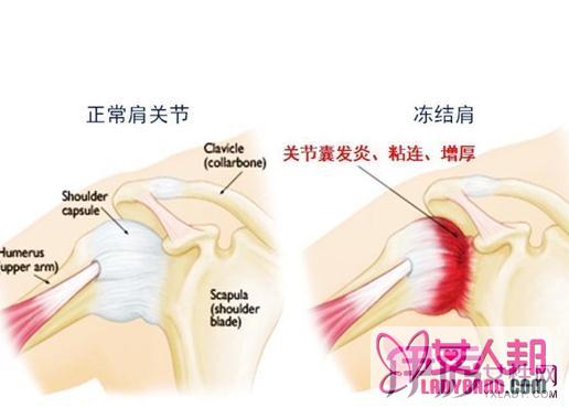 >肩周炎可以用炒盐热敷吗  3种方法让你缓解疼痛