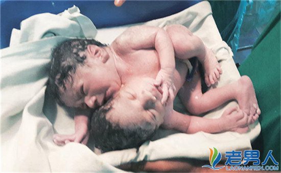 >印度罕见连体婴 共享一个器脏存活率渺茫