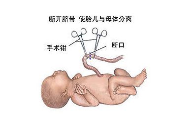 >【新生儿肚脐护理】新生儿肚脐掉了以后怎么护理