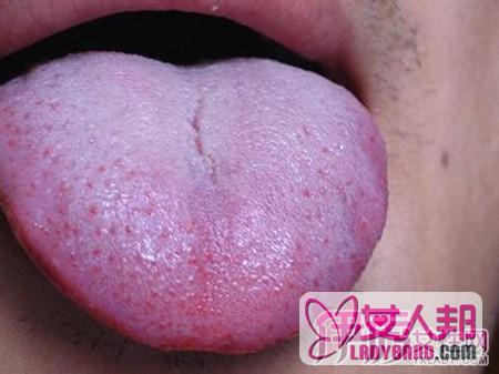 >艾滋病初期症状舌头显危机  区别艾滋看舌头