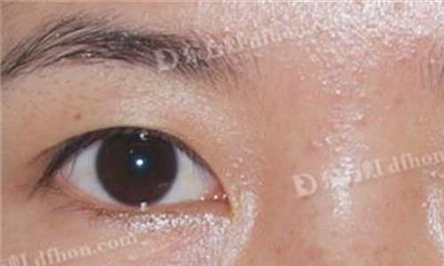 >激光祛眼袋 祛眼袋的后遗症有哪些 如何防治?