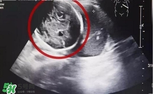 怀孕6月子宫为空 腹腔妊娠是什么意思