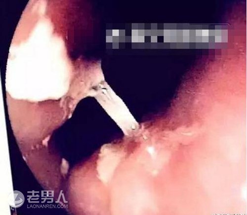 >男子肛门被鱼刺卡 网友：这玩的是刺激？