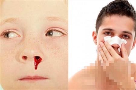 鼻子出血是什么原因 这两个情况你猜到了吗