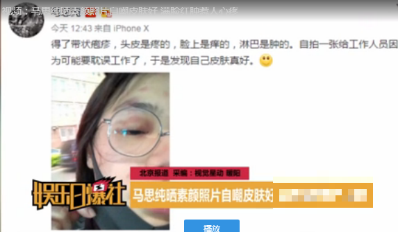 >马思纯脸上出现带状疱疹 脸都成这样了还工作 网友：为了我们,你可得照顾