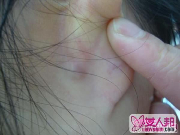 >颈突增生是不是耳后有硬包 耳朵后长硬包的原因