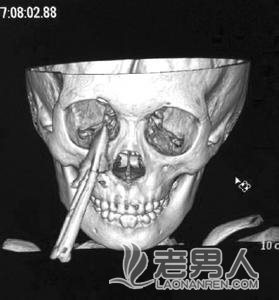 >工人被老板用筷子从眼眶插进脸5厘米 血流如注
