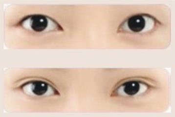 李沁奕双变单 北京最好的双眼皮专家李沁奕完美重睑术最新标准
