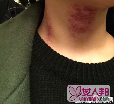 杨丞琳晒颈部刮痧照 网友：我感受过，真的痛(图)