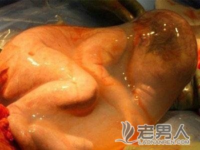 >剖腹产宝宝从妈妈肚子里出来的瞬间（组图）