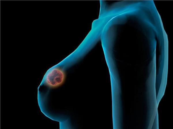 病理李挺 李挺:乳腺癌病理学进展及面临的主要挑战