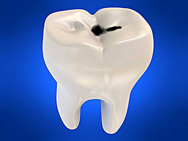蛀牙是怎么形成的 会有什么后遗症