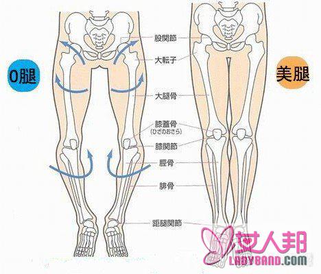 >o型腿是怎么形成的？ 膝内翻治理方法