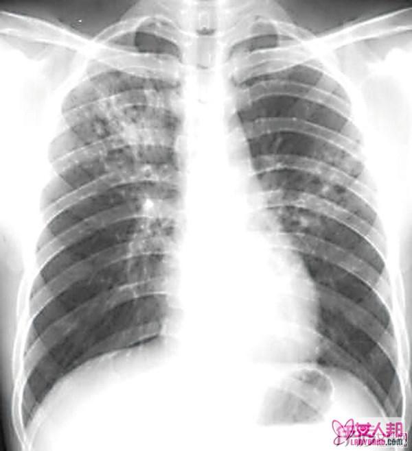 >肺积水是什么病 肺积水严重吗 肺积水早期症状 肺积水如果治疗