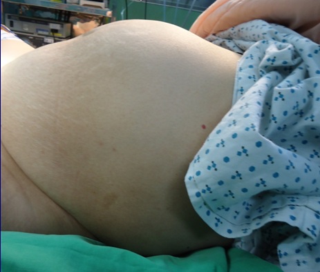 >有子多刑 经量增多且腹部有包块 49岁女子长了个5斤重的子宫肌瘤