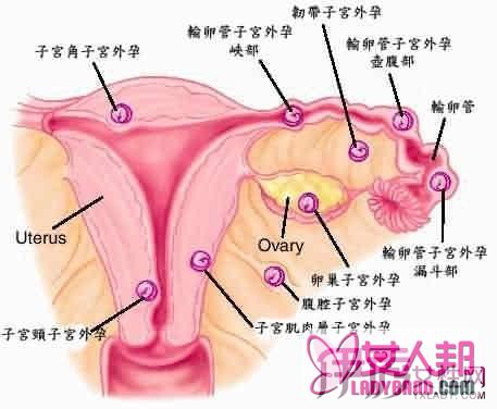 宫外孕术后要注意什么 盘点宫外孕六大病因