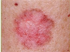 >皮肤癌早期症状图片 皮肤癌的病因 皮肤癌的预防