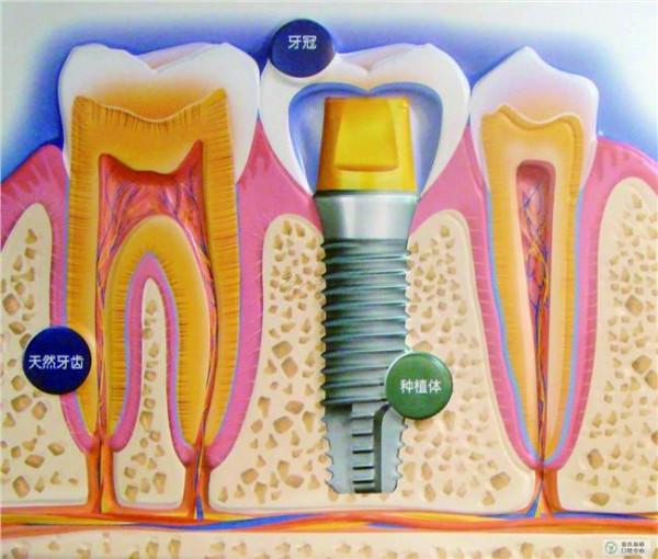 >吴祖泽再生牙 牙齿也可以再生?未来生物牙或代替种植牙