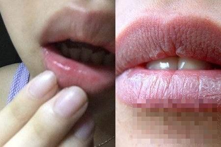 >嘴唇上长泡图片展示  三种方法可迅速缓解
