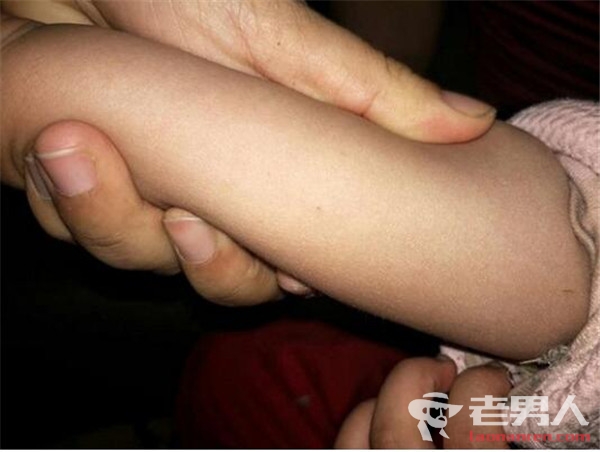 北京环宇幼儿园被指虐童 家长提供孩子身上的针眼以及病例（图）