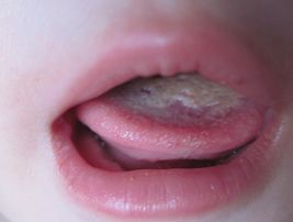 宝宝舌系带剪不剪舌系带短有什么症状