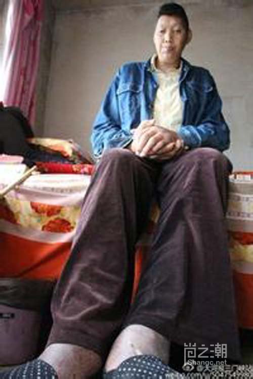 2 55米亚洲第一巨人王峰军去世 揭秘巨人症症状