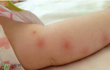 >婴儿蚊子咬了怎么消肿？婴儿蚊子咬了怎么消肿止痒最快？