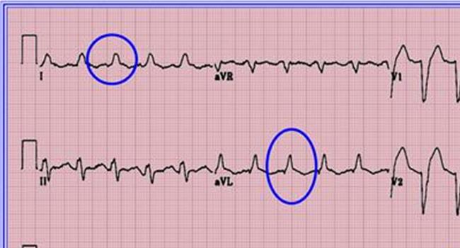 心电图t波改变什么意思