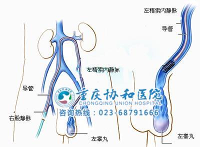 >双侧精索静脉正常值是多少【推荐】