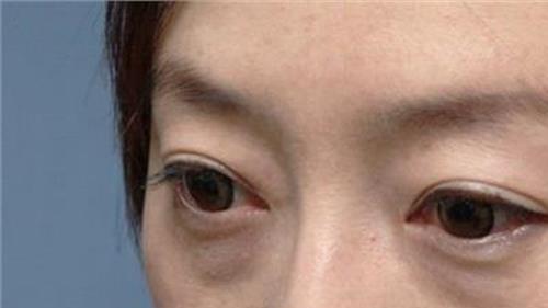 7个方法快速去除黑眼圈 如何消除黑眼圈?有效消除黑眼圈的办法