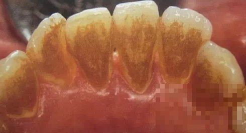 >牙龈出血、口臭是牙周炎晚期，你不可不知的5个预防小细节