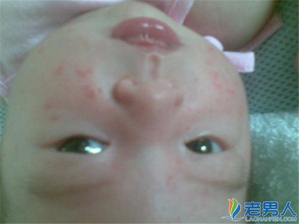 什么原因导致新生儿满身起红疹及日常处理办法有哪些