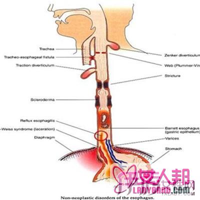 >返流性食道炎的症状有哪些 还有几个鲜为人知的表现