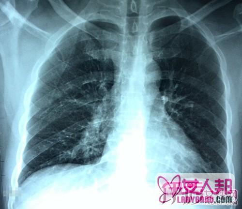 >肺气肿患者的寿命有多长 肺气肿的病因和临床表现