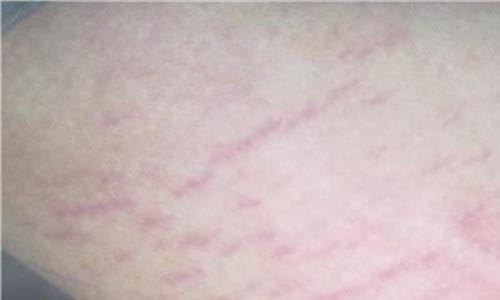 生长纹严重怎么办 什么是“生长纹” 生长纹是皮肤病吗?