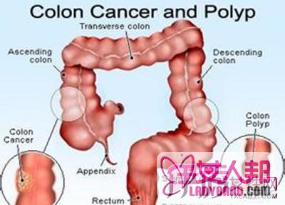 >结肠癌和直肠癌哪个严重  有哪些区别和预防方式？