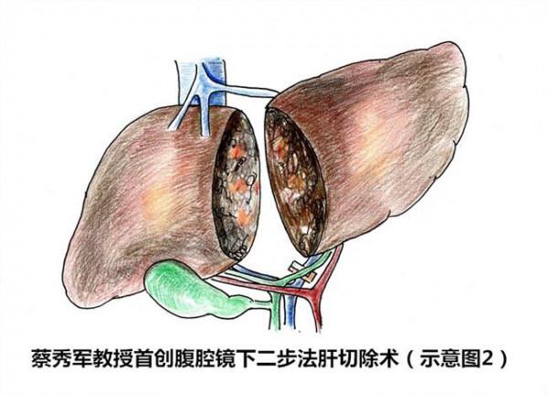 >蔡秀军浙二 蔡秀军教授首创腹腔镜二步法肝切除术