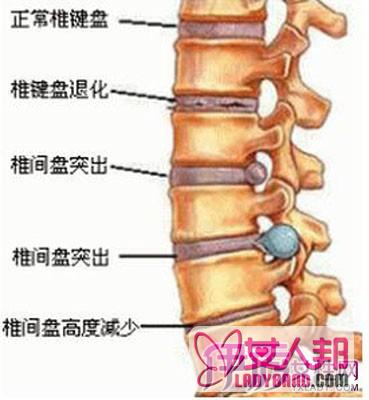 >腰椎间盘突出微创手术 做此手术有什么优势？