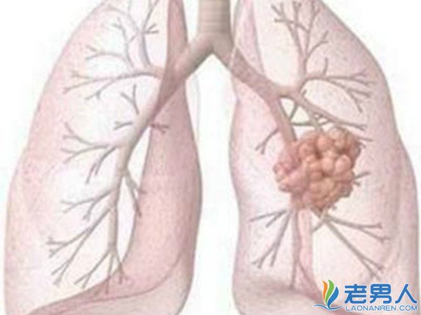 >肺结核是什么病会传染吗 有效的治疗方法是什么