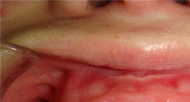 【成人矫正牙齿的后遗症】成人矫正牙齿后遗症是哪些