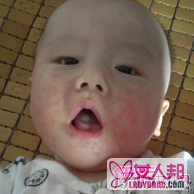 小儿荨麻疹的症状有哪些    认准病因早发现早治疗