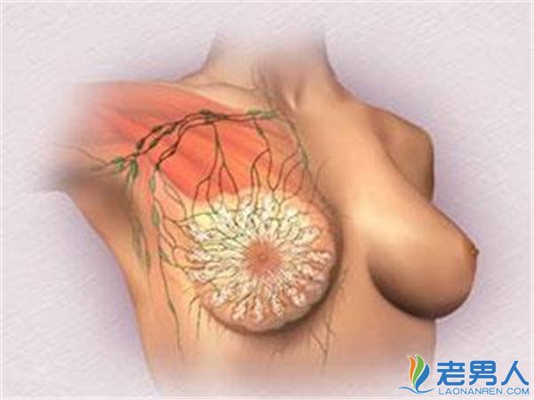 乳腺癌病因症状介绍 如何预防摆脱病痛
