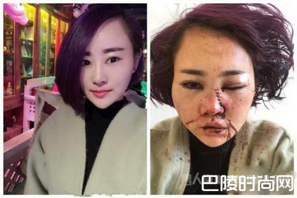 丽江被打毁容女孩公开近照：绝望中挣扎 事件全回顾