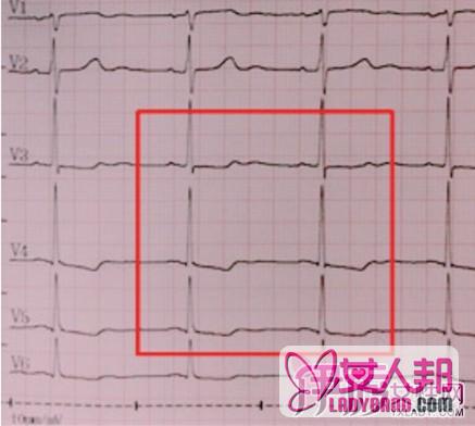 >心电图st段压低的原因 及其病症治疗方法