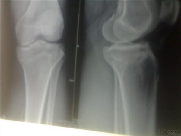 余家阔前交叉韧带断裂 急性前交叉韧带断裂合并膝关节骨挫伤的临床研究