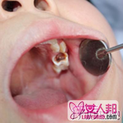 >专家解答牙齿开裂怎么办 早治疗早健康以防万一