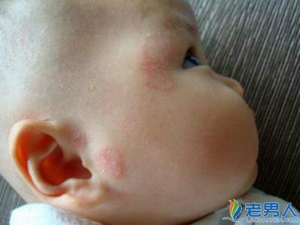 >婴儿患湿疹时怎么办 在治疗期间需要注意什么